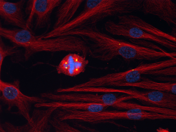 Centrosome amplification in cancer
