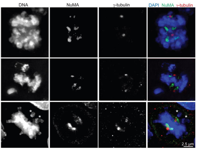 Paclitaxel induces multipolar spindles in human breast cancers